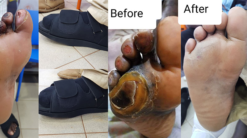 Foot-Care; A Concept that should be given Attention